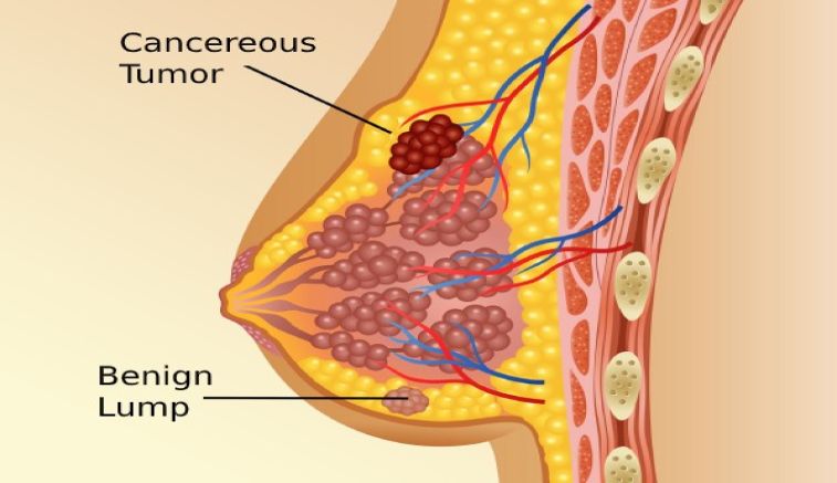 Alarming Burden of the Nation- Breast Cancer