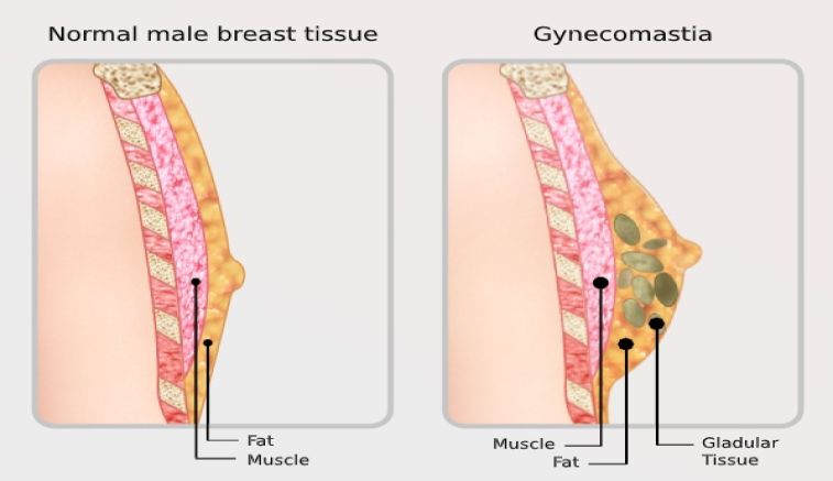 Informative Approach On Gynecomastia Surgery In Delhi And Haryana