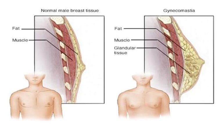 Gynecomastia Condition