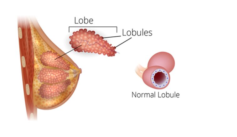 What are the Treatment Options for Breast Cancer?