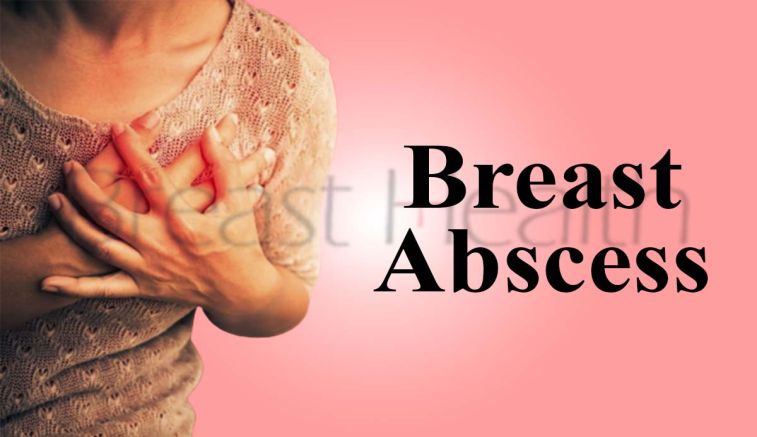 Understanding Breast Abscess: Causes, Symptoms, Treatment, and Prevention