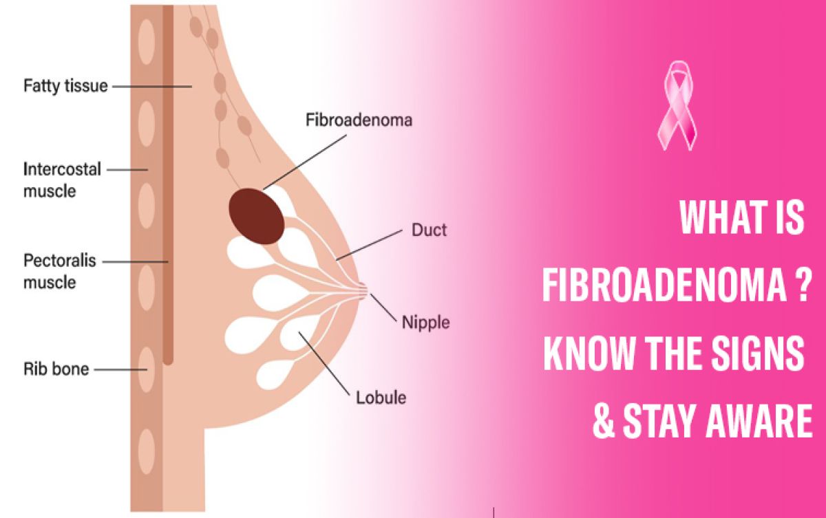 What is Fibroadenoma | Know The Signs & Stay Aware