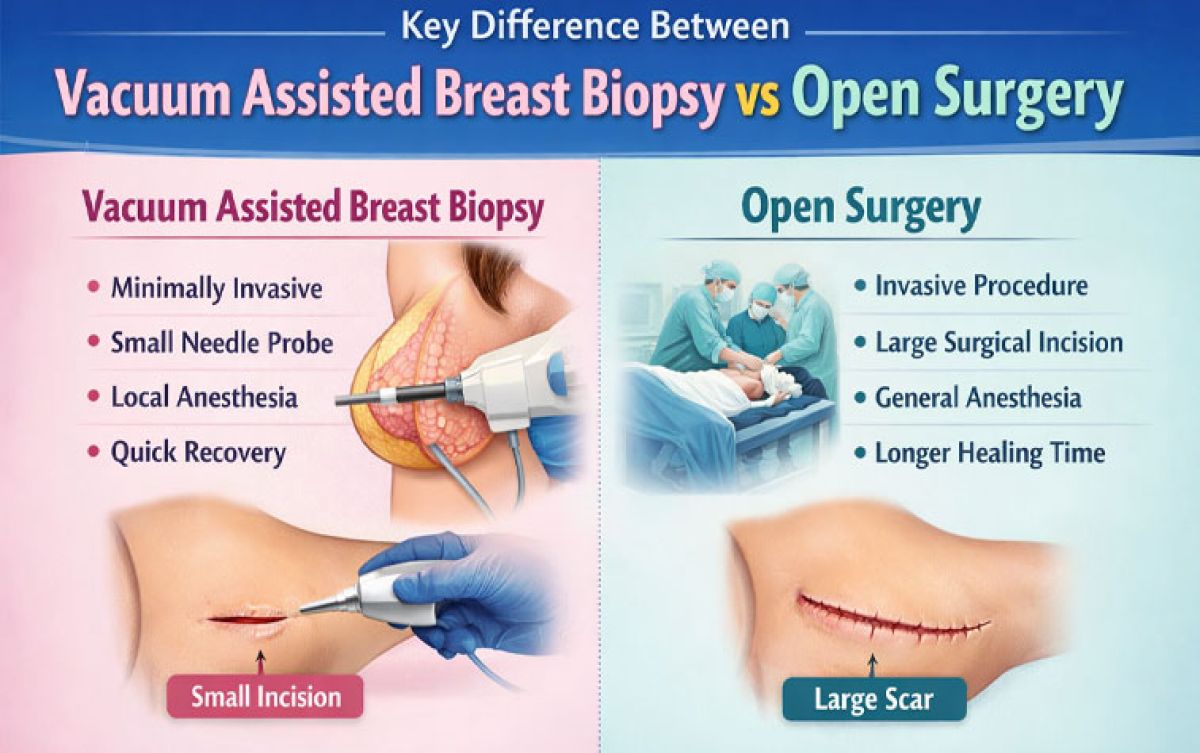 Key Difference between Vacuum Assisted Breast Biopsy vs Open Surgery