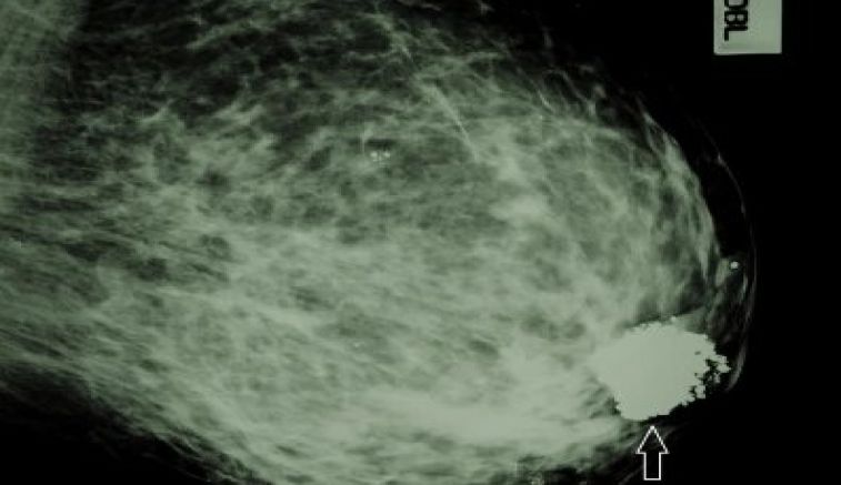 All breast fibroadenomas don’t require surgery