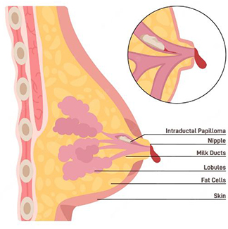 Nipple Papilloma Treatment