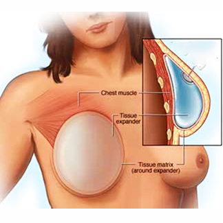 Breast Reconstruction