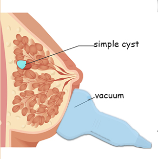 Vacuum Assisted Breast Surgery