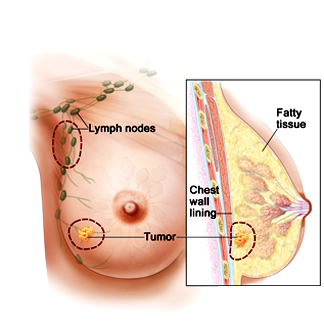 Breast Conservation Treatment