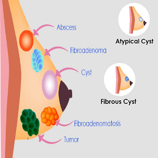 Fibroadenoma Treatment