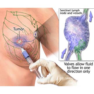 Sentinel Lymph Nodes Biopsy