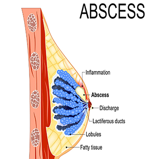 Breast Abscess