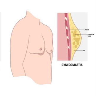 Gynecomastia Treatment